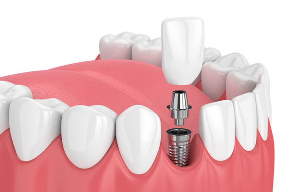 Rendering of jaw with dental implant