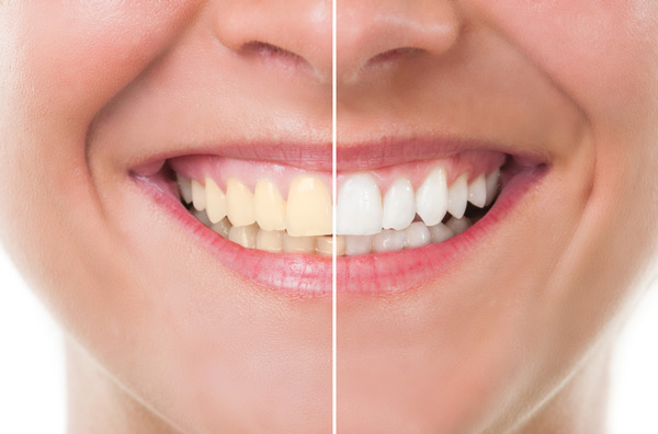 Before and after photo of teeth whitening treatment
